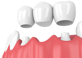 a 3D illustration of a traditional dental bridge