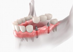 a 3D example of an implant dental bridge