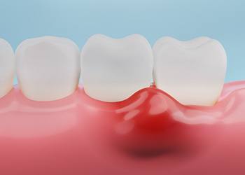 Illustration of gum disease