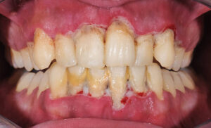 Picture of a mouth with advanced gum disease